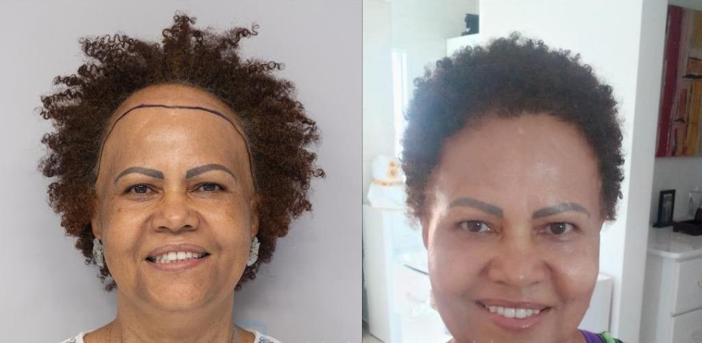 Illustrative hair density improvement example
