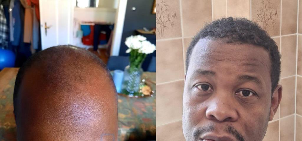 Illustrative hairline restoration direction