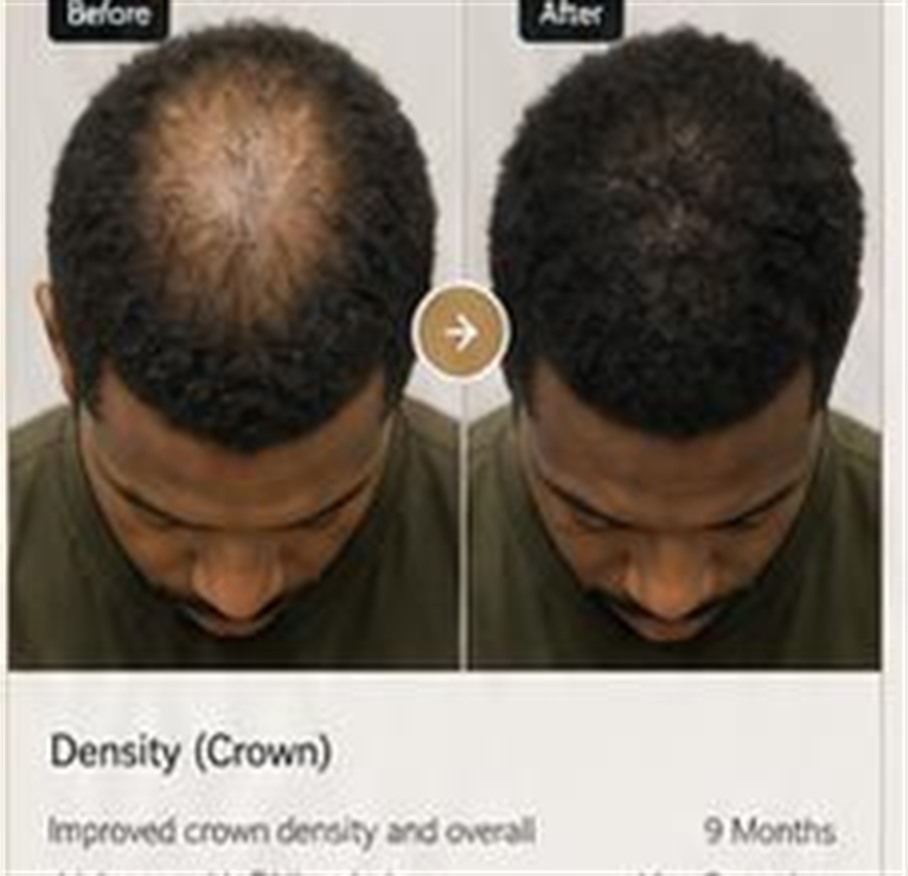 Illustrative crown density direction