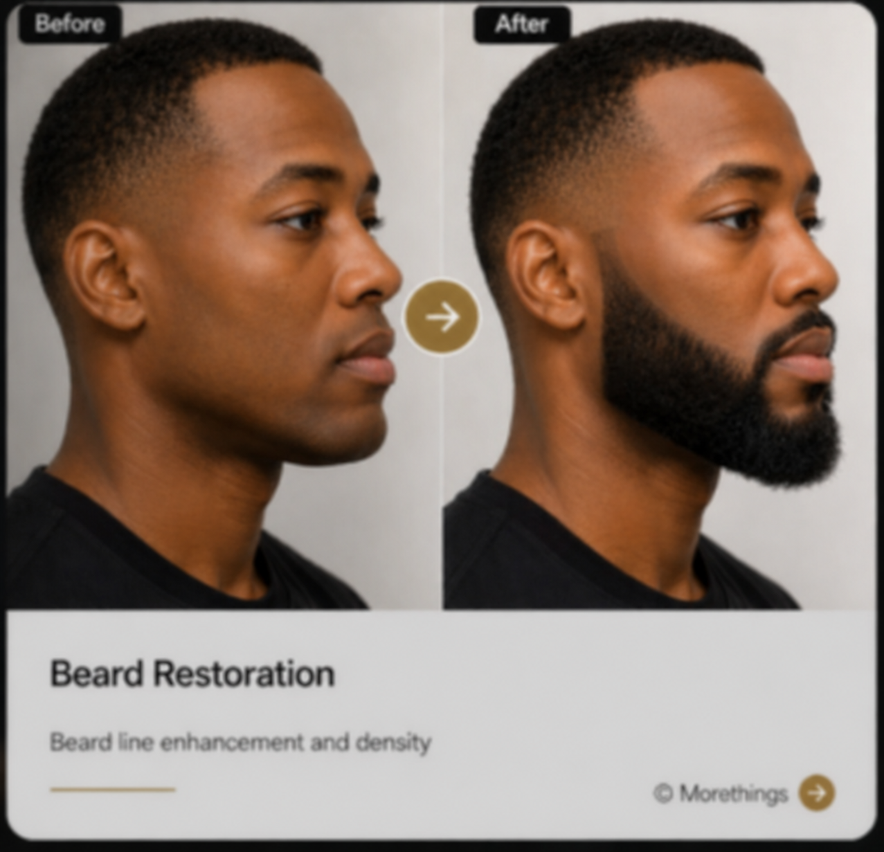 Illustrative beard restoration direction
