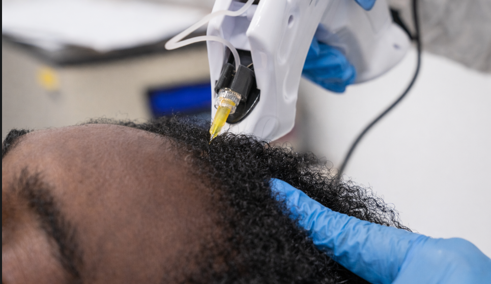 Direct hair implantation device being used during a DHI procedure