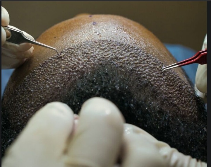 Specialist graft placement process supporting beard restoration treatment